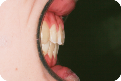 側貌⾯観|治療後