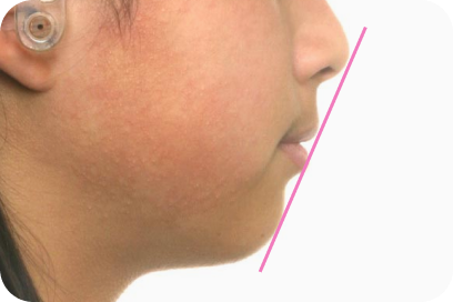 側貌⾯観｜治療後