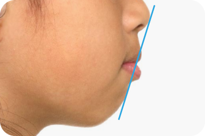 側貌⾯観｜治療前